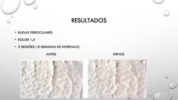 Curso Microagulhamento Syma Instituto