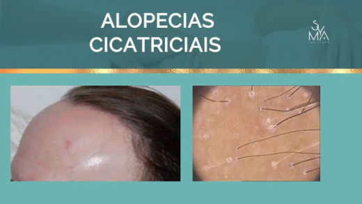 Curso Terapia Capilar Syma Instituto
